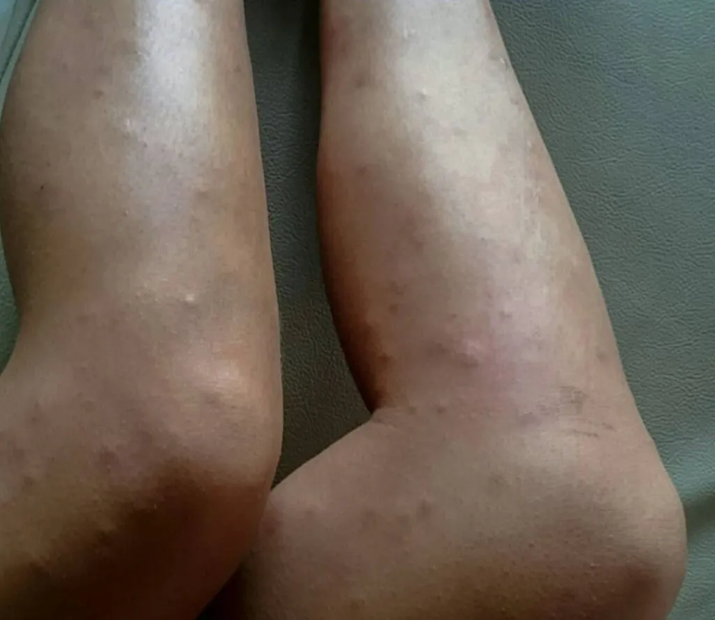 11 things to know about costa rica bug bites